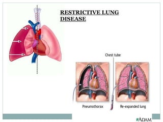 RESTRICTIVE LUNG
DISEASE
 
