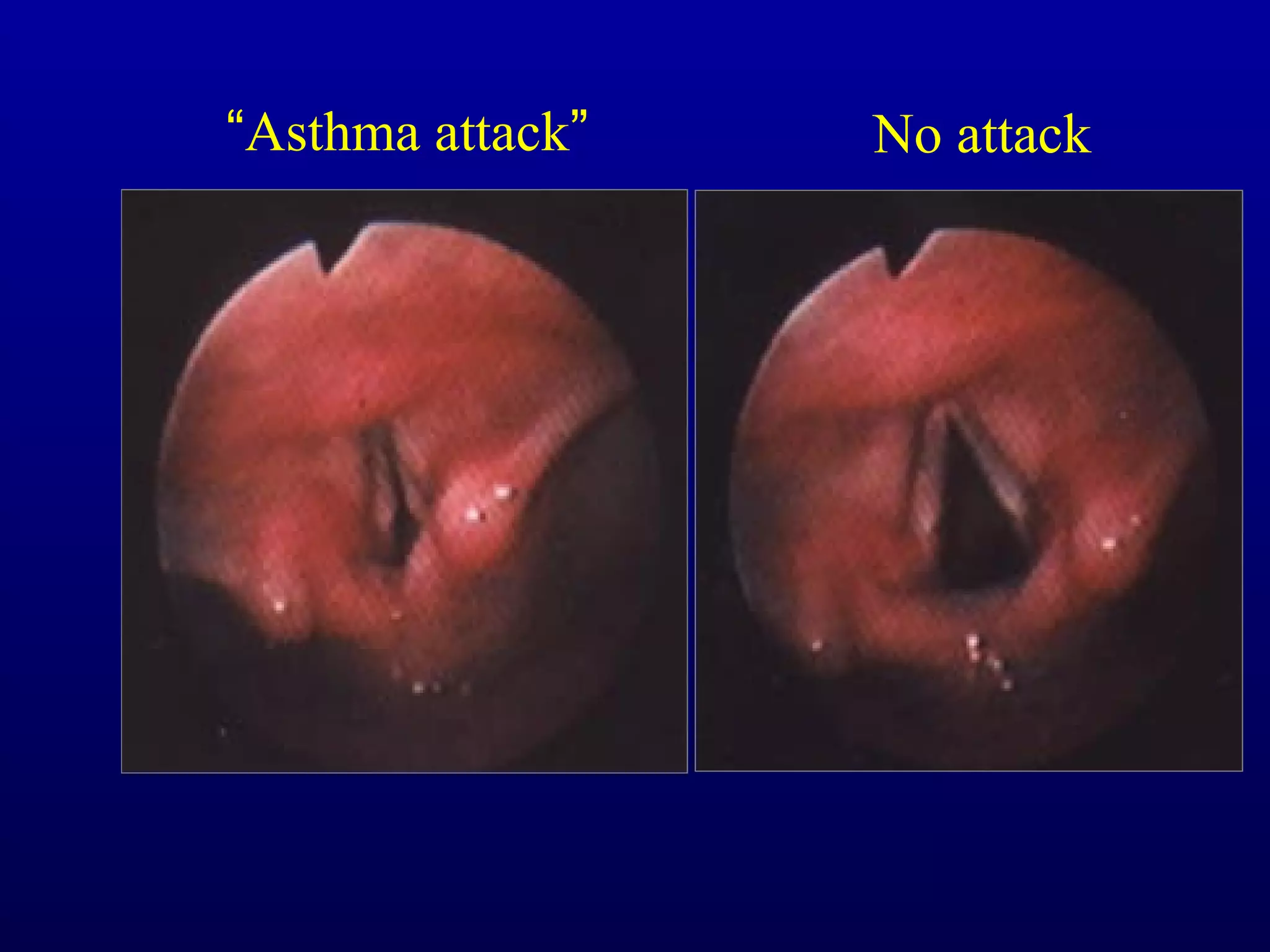 “Asthma attack” No attack
 