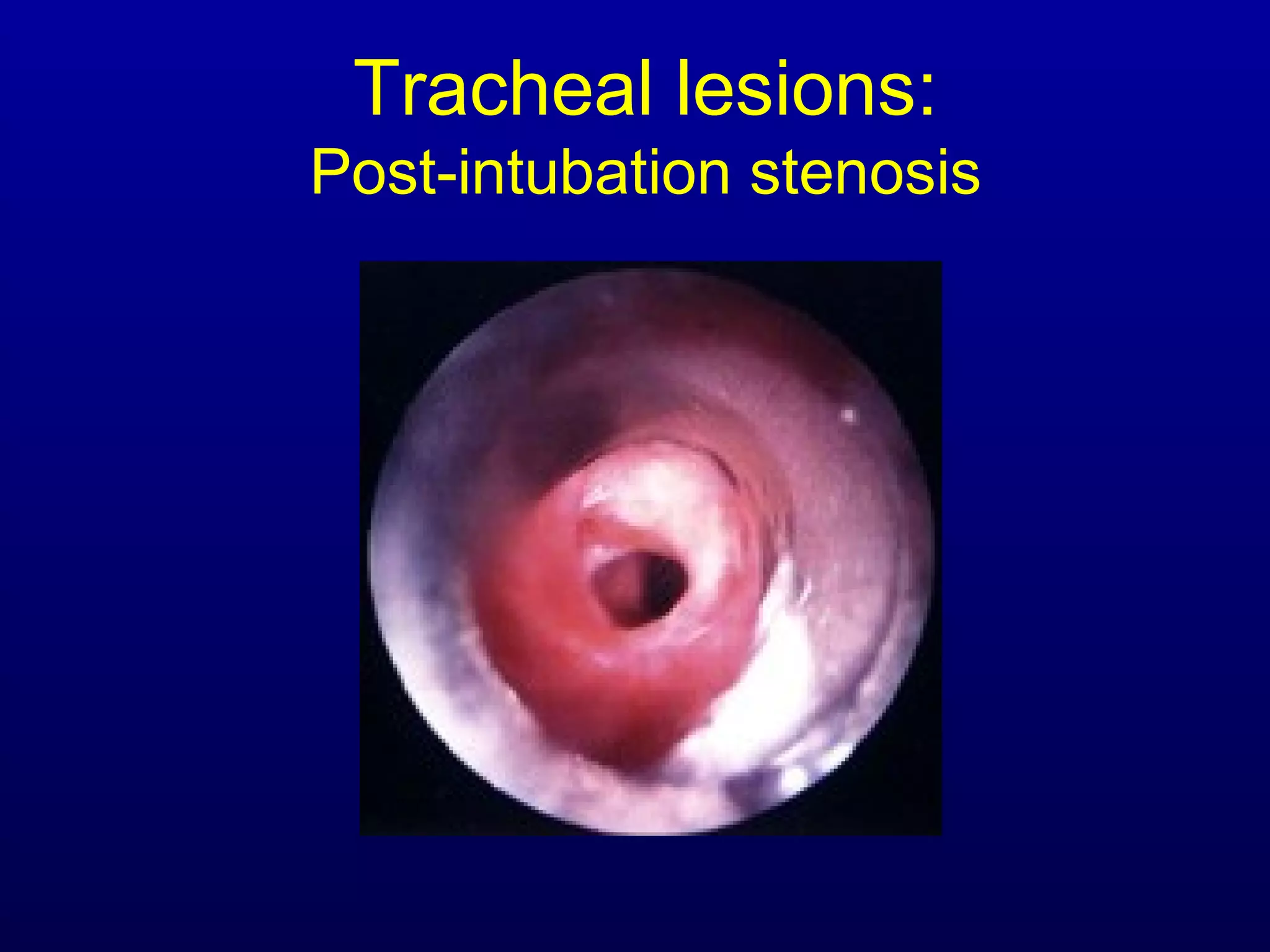 Tracheal lesions:
Post-intubation stenosis
 