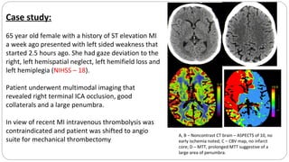 Case study:
65 year old female with a history of ST elevation MI
a week ago presented with left sided weakness that
started 2.5 hours ago. She had gaze deviation to the
right, left hemispatial neglect, left hemifield loss and
left hemiplegia (NIHSS – 18).
Patient underwent multimodal imaging that
revealed right terminal ICA occlusion, good
collaterals and a large penumbra.
In view of recent MI intravenous thrombolysis was
contraindicated and patient was shifted to angio
suite for mechanical thrombectomy
A B
C D
A, B – Noncontrast CT brain – ASPECTS of 10, no
early ischemia noted; C – CBV map, no infarct
core; D – MTT, prolonged MTT suggestive of a
large area of penumbra.
 