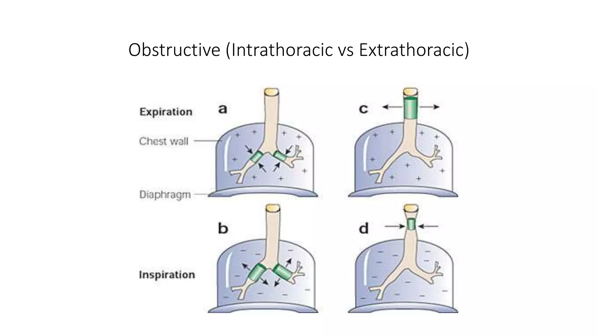 Obstructive (Intrathoracic vs Extrathoracic)
 