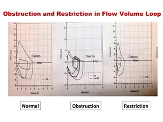 Obstruction and Restriction in Flow Volume Loop
Normal Obstruction Restriction
 