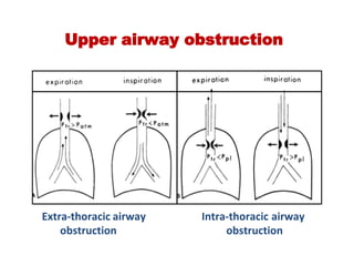 Upper airway obstruction
Extra‐thoracic airway                    Intra‐thoracic airway
       obstruction                                         obstruction
 