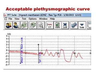 Acceptable plethysmographic curve
 
