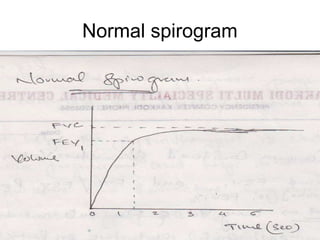 Normal spirogram
 