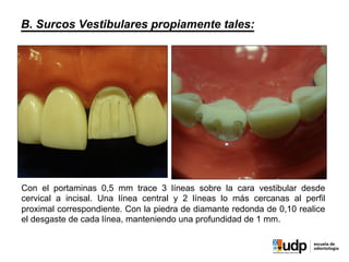 B. Surcos Vestibulares propiamente tales:
Con el portaminas 0,5 mm trace 3 líneas sobre la cara vestibular desde
cervical a incisal. Una línea central y 2 líneas lo más cercanas al perfil
proximal correspondiente. Con la piedra de diamante redonda de 0,10 realice
el desgaste de cada línea, manteniendo una profundidad de 1 mm.
 