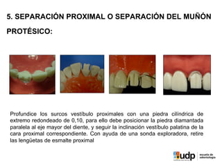 5. SEPARACIÓN PROXIMAL O SEPARACIÓN DEL MUÑÓN
PROTÉSICO:
Profundice los surcos vestíbulo proximales con una piedra cilíndrica de
extremo redondeado de 0,10, para ello debe posicionar la piedra diamantada
paralela al eje mayor del diente, y seguir la inclinación vestíbulo palatina de la
cara proximal correspondiente. Con ayuda de una sonda exploradora, retire
las lengüetas de esmalte proximal
 