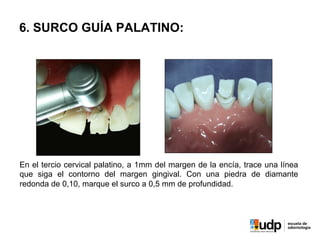 6. SURCO GUÍA PALATINO:
En el tercio cervical palatino, a 1mm del margen de la encía, trace una línea
que siga el contorno del margen gingival. Con una piedra de diamante
redonda de 0,10, marque el surco a 0,5 mm de profundidad.
 