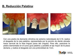 B. Reducción Palatina:
Con una piedra de diamante cilíndrica de extremo redondeado de 0,10, realice
el desgaste de la cara palatina, representada por la porción de diente ubicada
hacia cervical de la fosa lingual (zona del cíngulo). Para ello, posicione la
piedra diamantada en el surco guía palatino y paralelo al eje mayor de la pieza
dentaria, y realice el desgaste con una profundidad de 1mm.
 