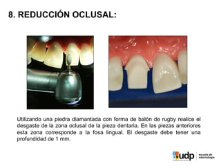 8. REDUCCIÓN OCLUSAL:
Utilizando una piedra diamantada con forma de balón de rugby realice el
desgaste de la zona oclusal de la pieza dentaria. En las piezas anteriores
esta zona corresponde a la fosa lingual. El desgaste debe tener una
profundidad de 1 mm.
 