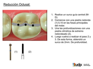 PRECLÍNICO	
  Y	
  BIOMATERIALES	
  IV	
  
Reducción Oclusal:
(1) (2)
(1) (1) (1)
(2)
1.  Realice un surco guía central (M-
D).
2.  Comience con una piedra redonda
(1) 0,10 en las fosas principales
del molar.
3.  Una las profundizaciones con una
piedra cilíndrica de extremo
redondeado (2).
4.  Luego vuelva a realizar el paso 2 y
3. De esta forma, obtendrá un
surco de 2mm. De profundidad.
 