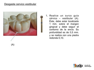 PRECLÍNICO	
  Y	
  BIOMATERIALES	
  IV	
  
(A)
Desgaste cervico vestibular
1.  Realice un surco guía
cérvico – vestibular (A).
Éste, debe estar localizado
1 mm. sobre el margen
gingival y debe seguir el
contorno de la encía. Su
profundidad es de 0,5 mm.
y se realiza con una piedra
redonda 0,10.
 