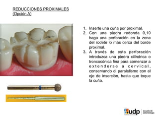 PRECLÍNICO	
  Y	
  BIOMATERIALES	
  IV	
  
REDUCCIONES PROXIMALES
(Opción A)
1.  Inserte una cuña por proximal.
2.  Con una piedra redonda 0,10
haga una perforación en la zona
del rodete lo más cerca del borde
proximal.
3.  A través de esta perforación
introduzca una piedra cilíndrica o
troncocónica fina para comenzar a
e x t e n d e r s e a c e r v i c a l ,
conservando el paralelismo con el
eje de inserción, hasta que toque
la cuña.
 