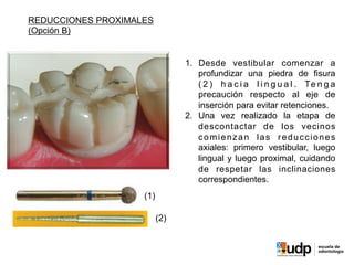 PRECLÍNICO	
  Y	
  BIOMATERIALES	
  IV	
  
REDUCCIONES PROXIMALES
(Opción B)
1.  Desde vestibular comenzar a
profundizar una piedra de fisura
( 2 ) h a c i a l i n g u a l . Te n g a
precaución respecto al eje de
inserción para evitar retenciones.
2.  Una vez realizado la etapa de
descontactar de los vecinos
comienzan las reducciones
axiales: primero vestibular, luego
lingual y luego proximal, cuidando
de respetar las inclinaciones
correspondientes.
(1)
(2)
 