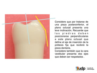 PRECLÍNICO	
  Y	
  BIOMATERIALES	
  IV	
  
Considere que por tratarse de
una pieza posteroinferior, el
plano oclusal presenta una
leve inclinación. Recuerde que
l a s p i e d r a s d e b e n
posicionarse perpendiculares
a este plano oclusal que
define el eje de inserción de la
prótesis fija que recibirá la
pieza dentaria.
Considere también que la cara
vestibular presenta dos ejes
que deben ser respetados .
 