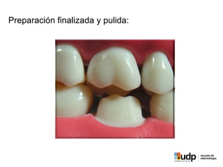 PRECLÍNICO	
  Y	
  BIOMATERIALES	
  IV	
  
Preparación finalizada y pulida:
 