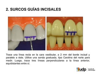 2. SURCOS GUÍAS INCISALES
Trace una línea recta en la cara vestibular, a 2 mm del borde incisal y
paralelo a éste. Utilice una sonda graduada, tipo Carolina del norte para
medir. Luego, trace tres líneas perpendiculares a la línea anterior,
equidistantes entre sí.
 