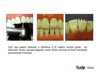 Con una piedra redonda o cilíndrica 0,10 realice surcos guías en
dirección inciso cervical dejando como límite cervical la línea horizontal
previamente marcada.
 