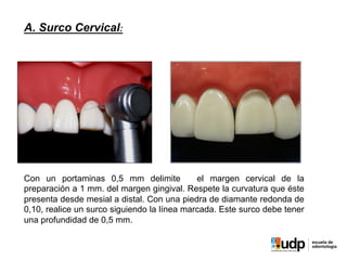 A. Surco Cervical:
Con un portaminas 0,5 mm delimite el margen cervical de la
preparación a 1 mm. del margen gingival. Respete la curvatura que éste
presenta desde mesial a distal. Con una piedra de diamante redonda de
0,10, realice un surco siguiendo la línea marcada. Este surco debe tener
una profundidad de 0,5 mm.
 