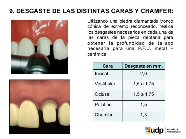Lineas De Terminacion En Protesis Fija Articulos