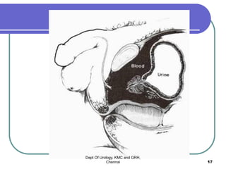 Dept Of Urology, KMC and GRH,
Chennai 17
 
