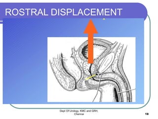 ROSTRAL DISPLACEMENT
Dept Of Urology, KMC and GRH,
Chennai 18
 