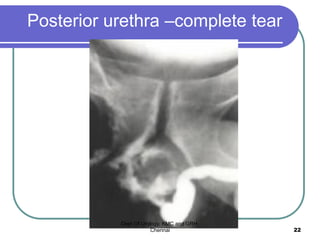 Posterior urethra –complete tear
Dept Of Urology, KMC and GRH,
Chennai 22
 