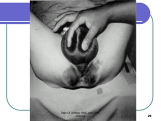 Dept Of Urology, KMC and GRH,
Chennai 29
 