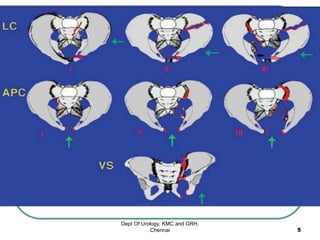 Dept Of Urology, KMC and GRH,
Chennai 5
 