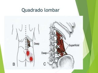 Quadrado lombar
 