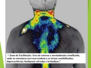 “ Zona de Facilitação: Área de estresse e normalmente cronificada,
onde as estruturas nervosas tendem a se tornar sensibilizadas,
hiperexcitáveis, facilmente ativadas e irritadiças.”
 