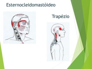 Esternocleidomastóideo
Trapézio
 