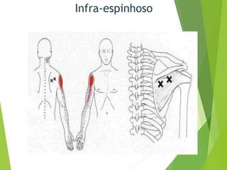 Infra-espinhoso
 