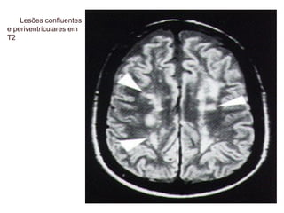 Lesões confluentes
e periventriculares em
T2
 