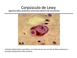Corpúsculo de Lewy
Aglomerados proteicos anormais dentro de neurônios
Inclusão citoplasmática eosinofílica, um núcleo denso com um halo de fibras protseicas, o
principal componente é alfa sinucleina.
 