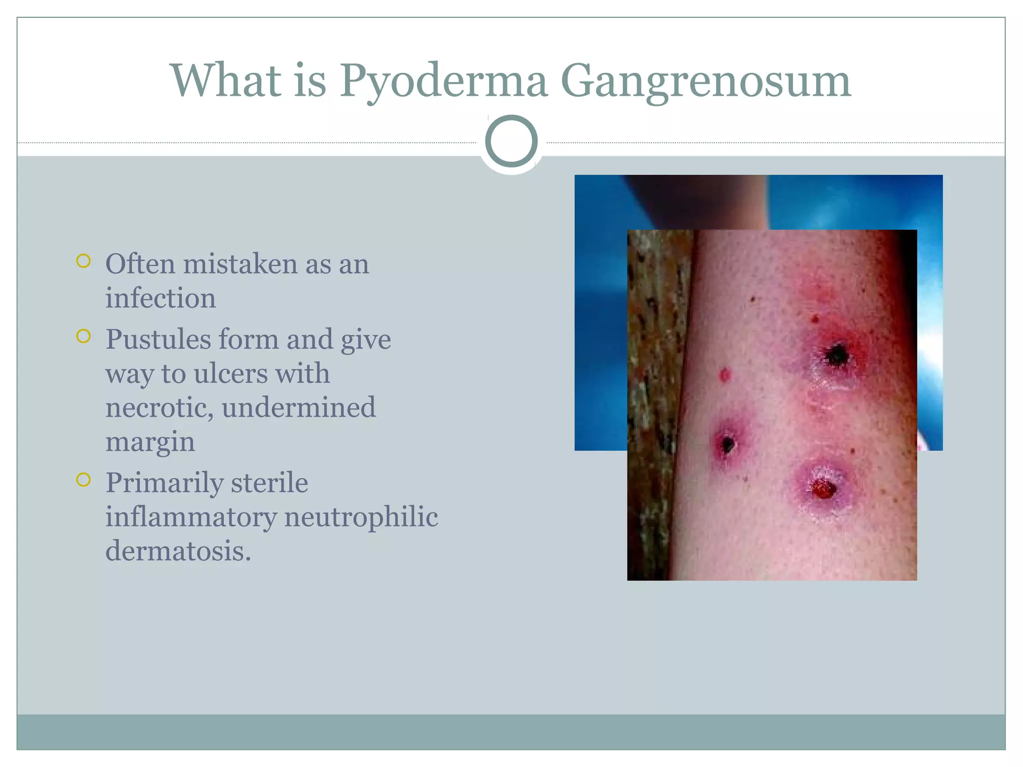 What is Pyoderma Gangrenosum
 Often mistaken as an
infection
 Pustules form and give
way to ulcers with
necrotic, undermined
margin
 Primarily sterile
inflammatory neutrophilic
dermatosis.
 