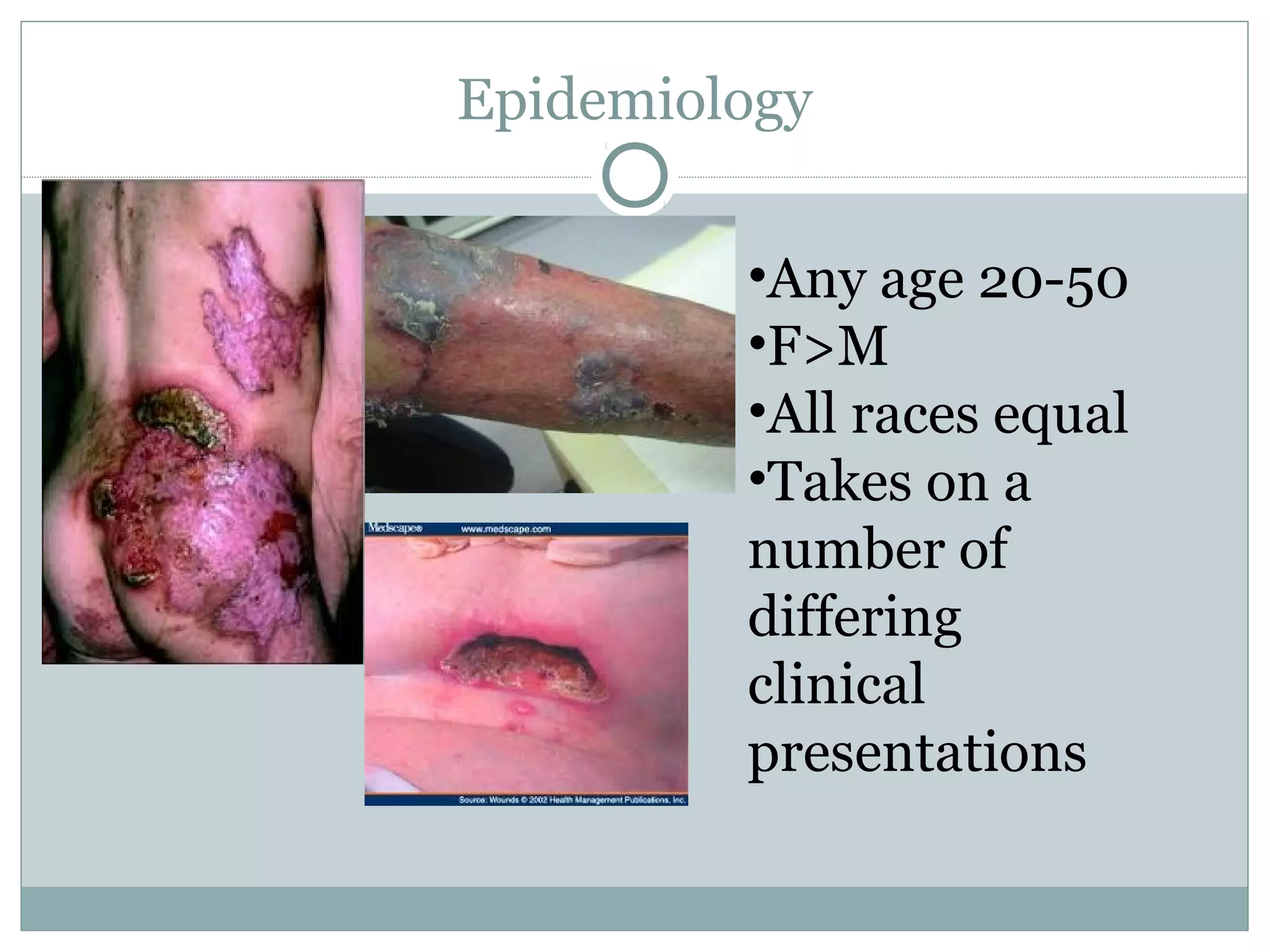 Epidemiology
•Any age 20-50
•F>M
•All races equal
•Takes on a
number of
differing
clinical
presentations
 