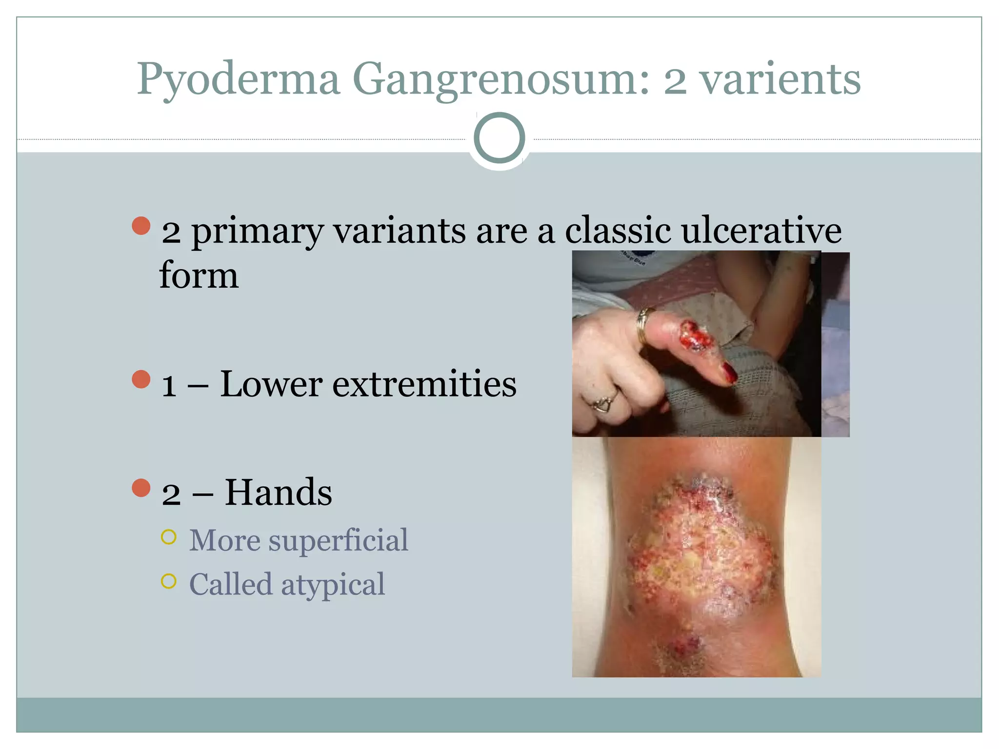 Pyoderma Gangrenosum: 2 varients
2 primary variants are a classic ulcerative
form
1 – Lower extremities
2 – Hands
 More superficial
 Called atypical
 