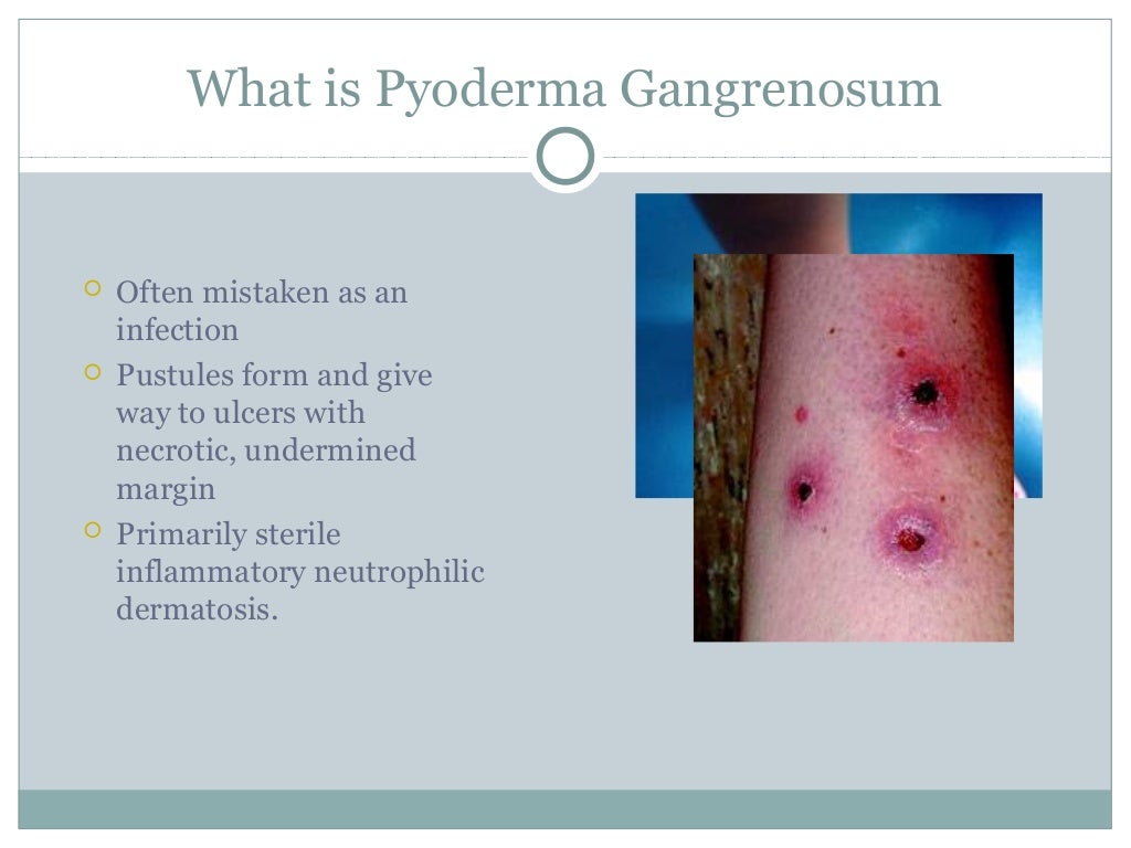Pyoderma Gangrenosum