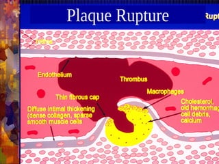 Plaque Rupture
 
