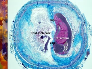 lipid-rich core
thrombus
cap
cap
 