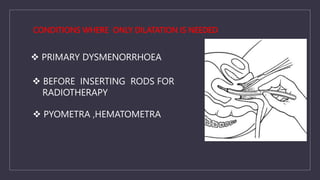 CONDITIONS WHERE ONLY DILATATION IS NEEDED
 PRIMARY DYSMENORRHOEA
 BEFORE INSERTING RODS FOR
RADIOTHERAPY
 PYOMETRA ,HEMATOMETRA
 