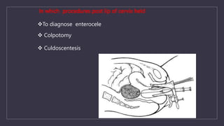 In which procedures post lip of cervix held
To diagnose enterocele
 Colpotomy
 Culdoscentesis
 