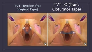 TVT –O (Trans
Obturator Tape)
 