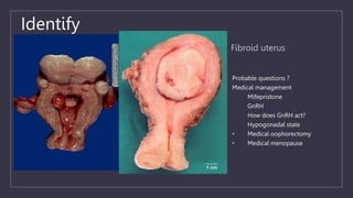 Identify
Fibroid uterus
Probable questions ?
Medical management
Mifepristone
GnRH
How does GnRH act?
Hypogonadal state
• Medical oophorectomy
• Medical menopause
 