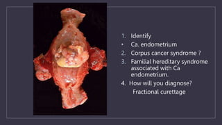 1. Identify
• Ca. endometrium
2. Corpus cancer syndrome ?
3. Familial hereditary syndrome
associated with Ca
endometrium.
4. How will you diagnose?
Fractional curettage
 