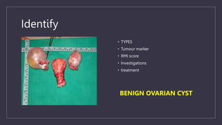 Identify
• TYPES
• Tumour marker
• RMI score
• Investigations
• treatment
BENIGN OVARIAN CYST
 