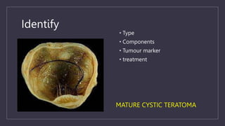 Identify
• Type
• Components
• Tumour marker
• treatment
MATURE CYSTIC TERATOMA
 