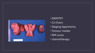 • IDENTIFY
• Ca Ovary
• Staging laparotomy
• Tumour marker
• RMI score
• chemotherapy
 