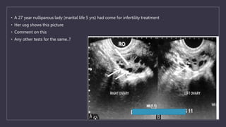 • A 27 year nulliparous lady (marital life 5 yrs) had come for infertility treatment
• Her usg shows this picture
• Comment on this
• Any other tests for the same..?
 